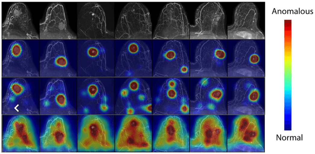 AI model from Microsoft and UW maps out breast cancer in MRIs with unprecedented accuracy