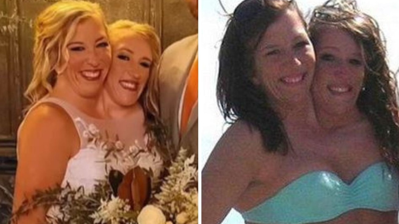 Legally, Abby and Brittany are two separate people