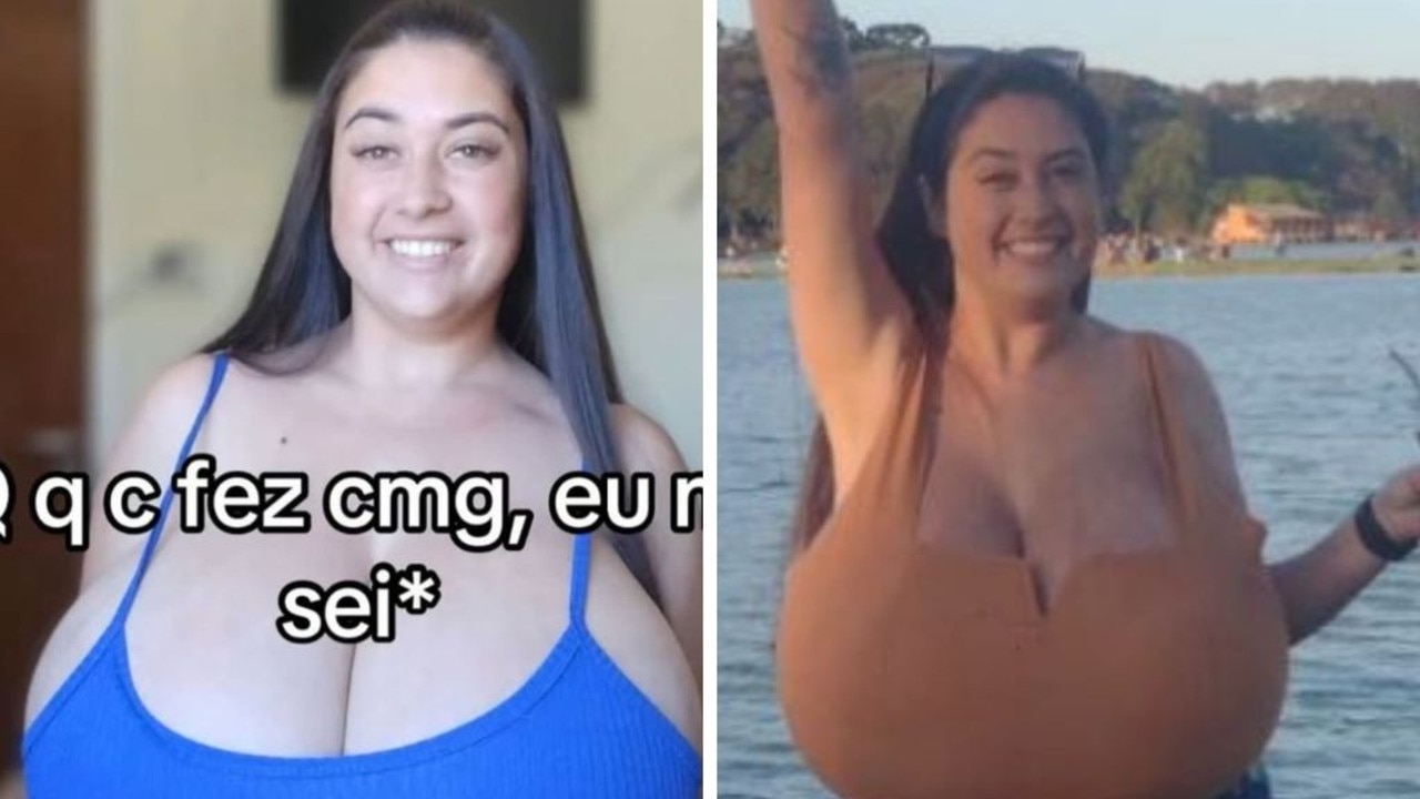 Brazilian woman one of 300 women diagnosed with breast issue