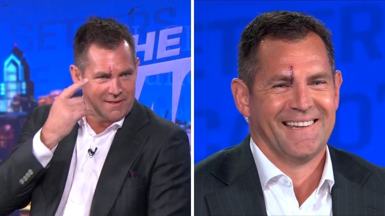 AFL great Luke Hodge sports nasty face injury on TV