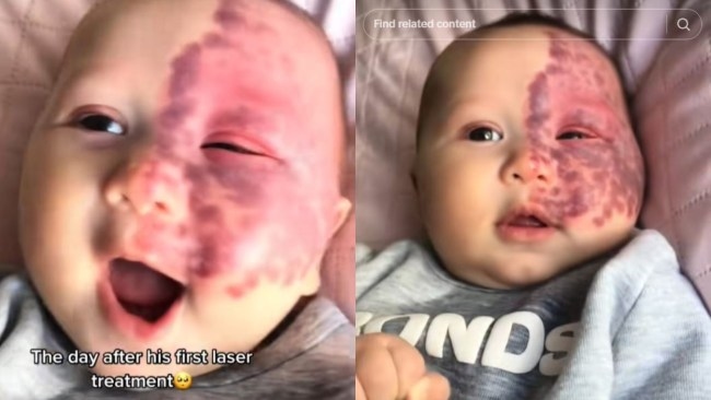 Aussie mum viciously branded a 'monster' by trolls for lasering birthmark on her baby's face reveals what her son, 3, looks like now