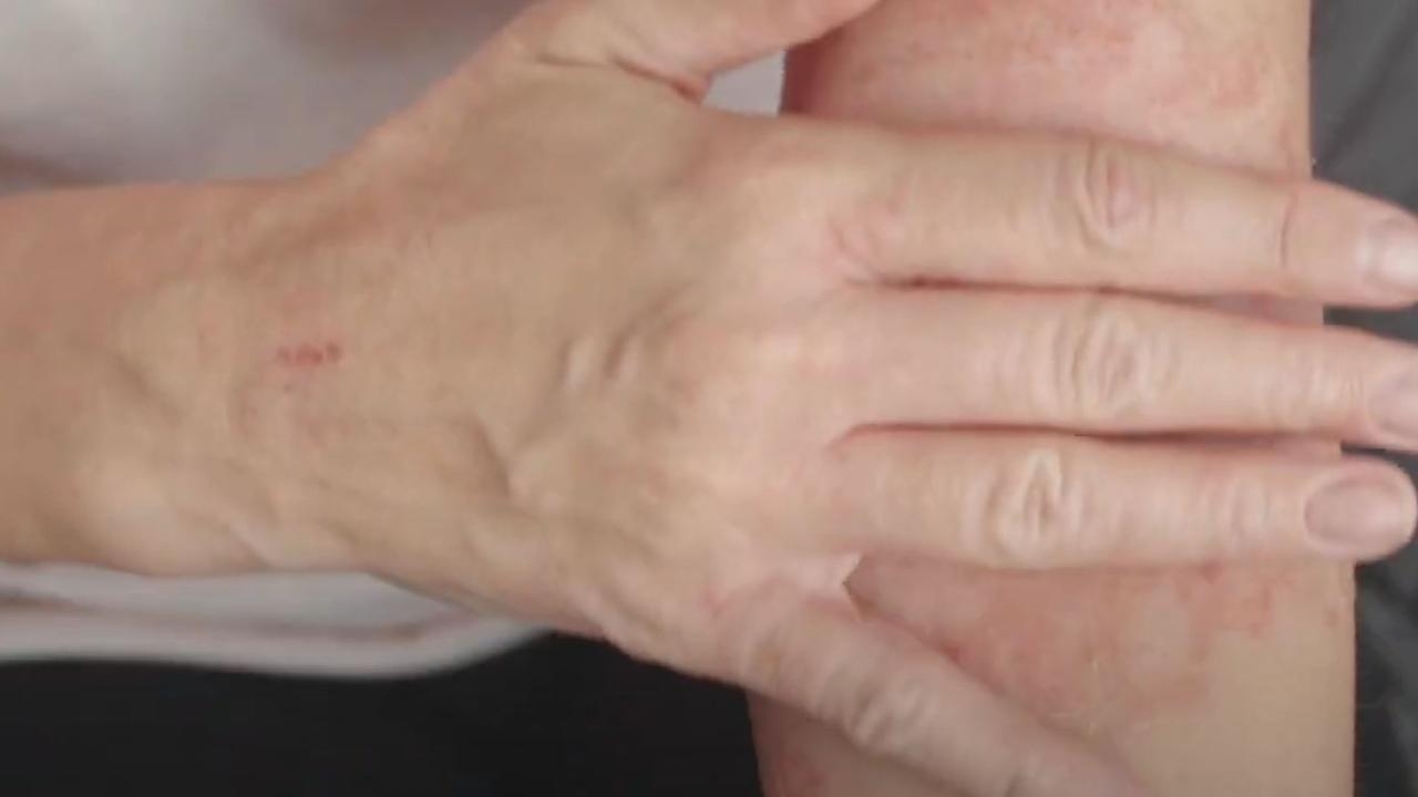 Winter is flaring up eczema for about a third of Aussies who suffer from the irritating skin condition