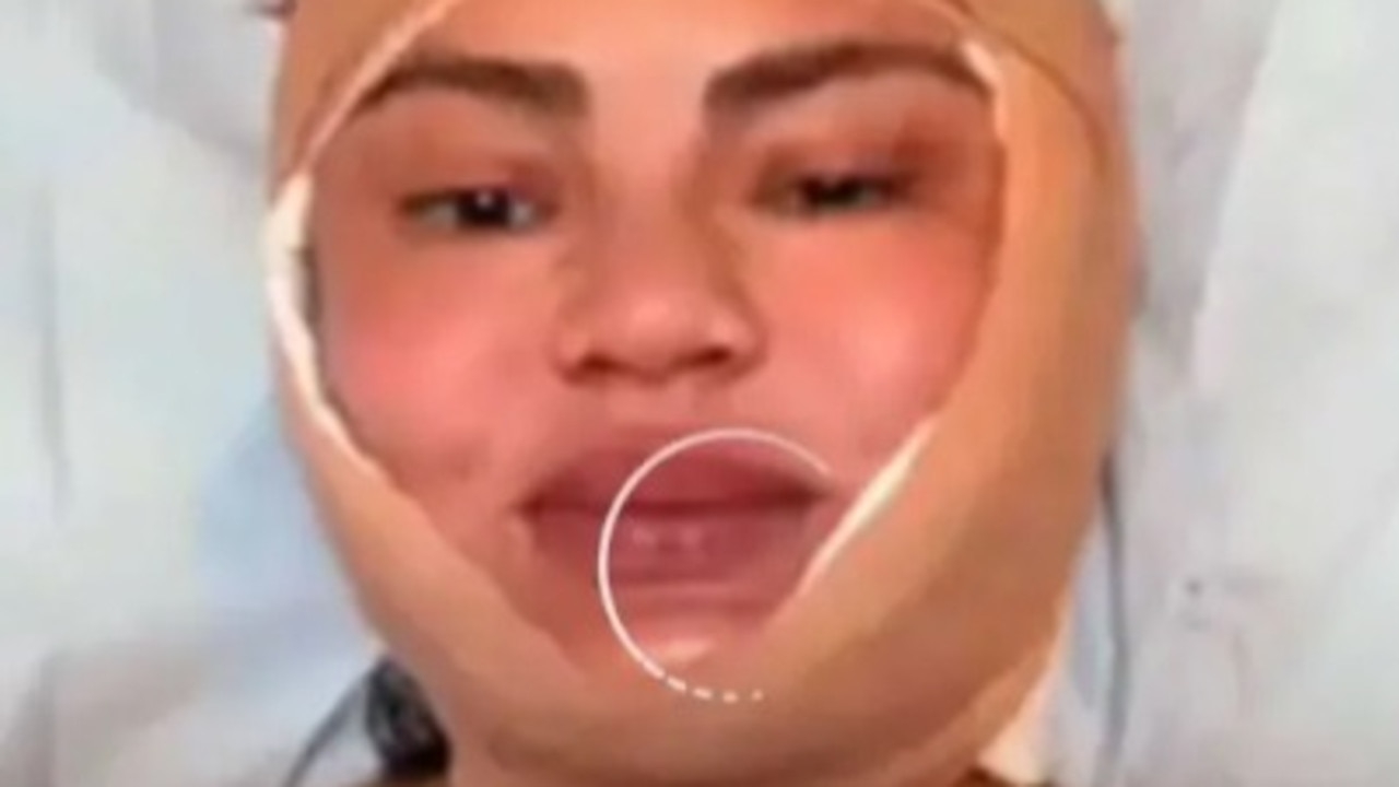 Chrissy Teigen goes public with drastic cosmetic surgery procedure