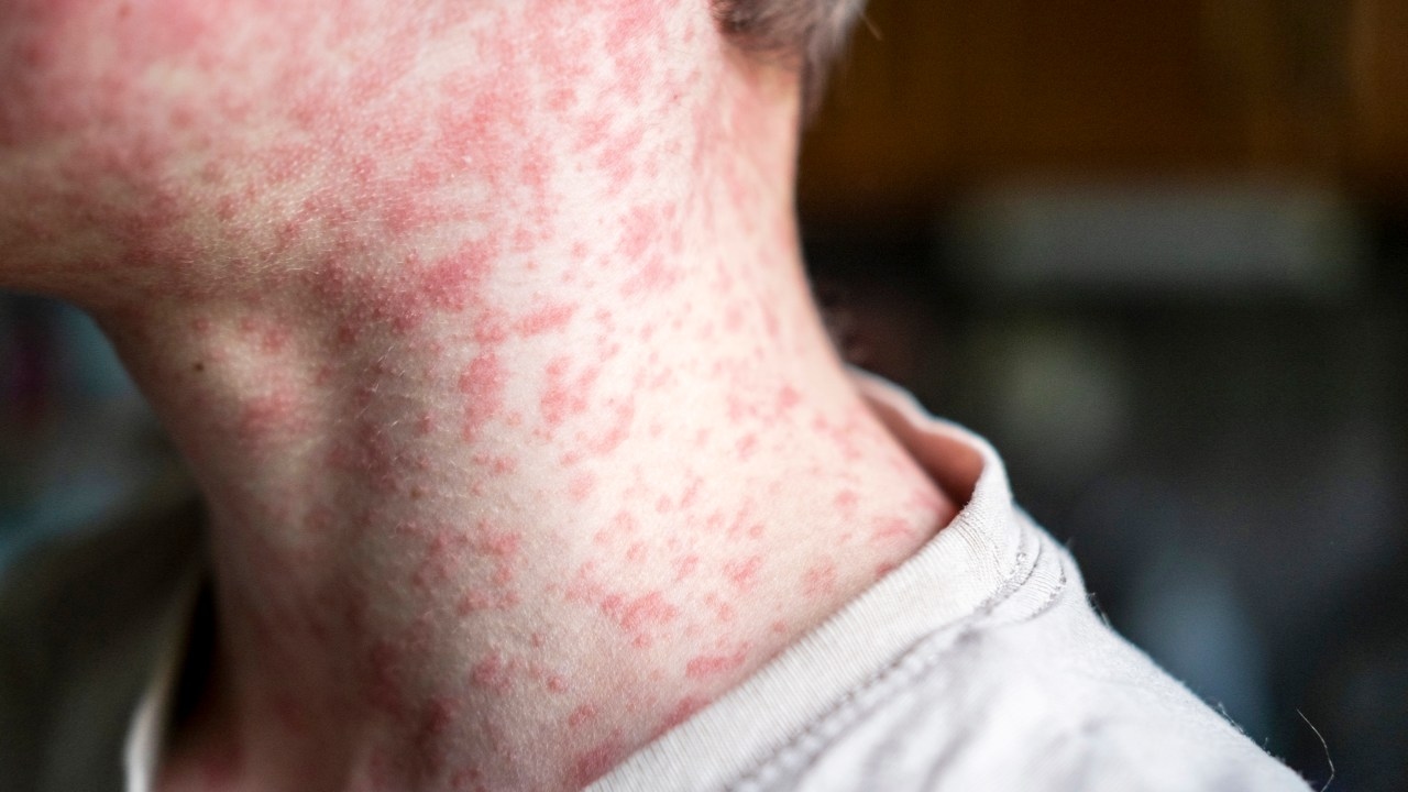 Alert issued by SA Health after Bali traveller returns to Adelaide with measles