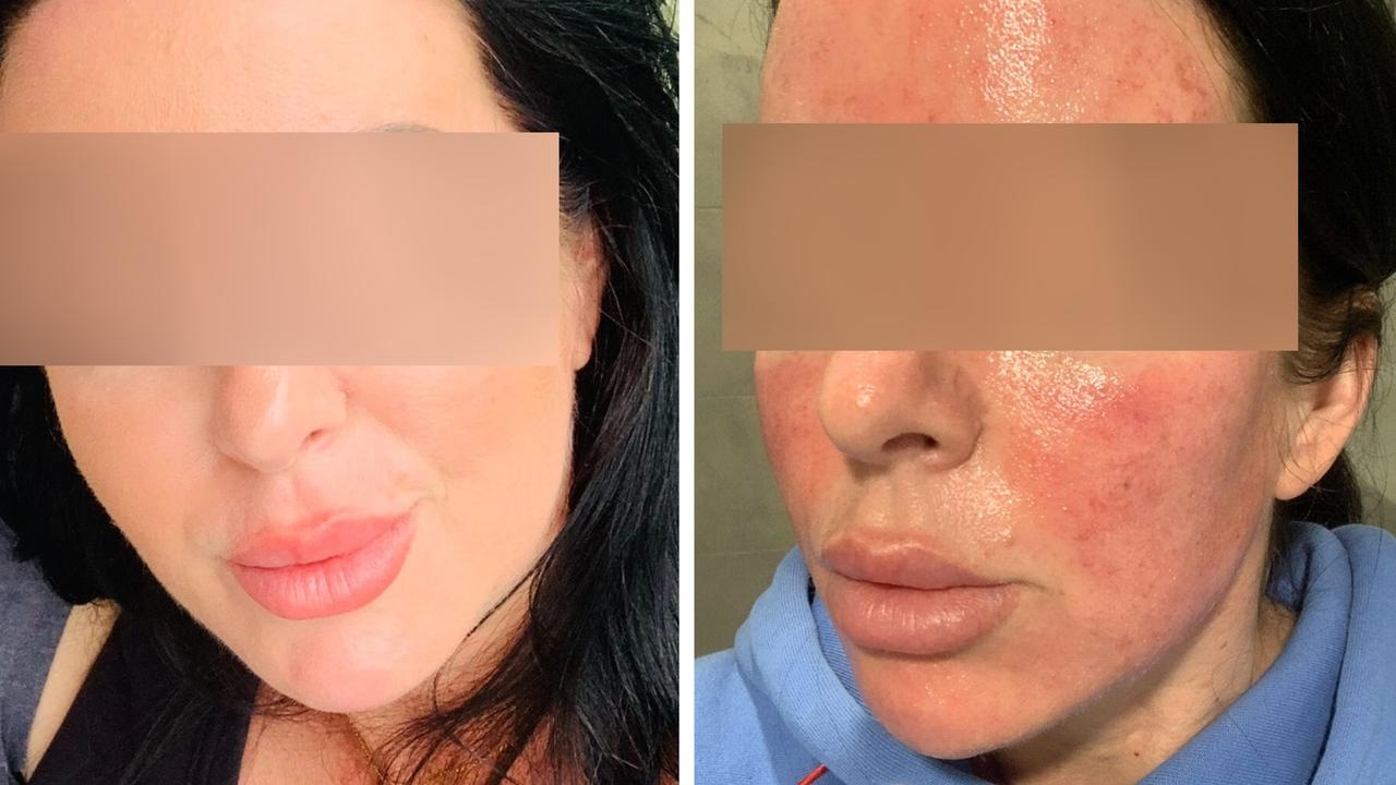 ‘Eyeballs burning': Mum's nightmare after popular cosmetic treatment