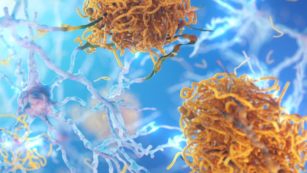 TGA approves Eli Lilly drug Kisunla in boost for dementia patients
