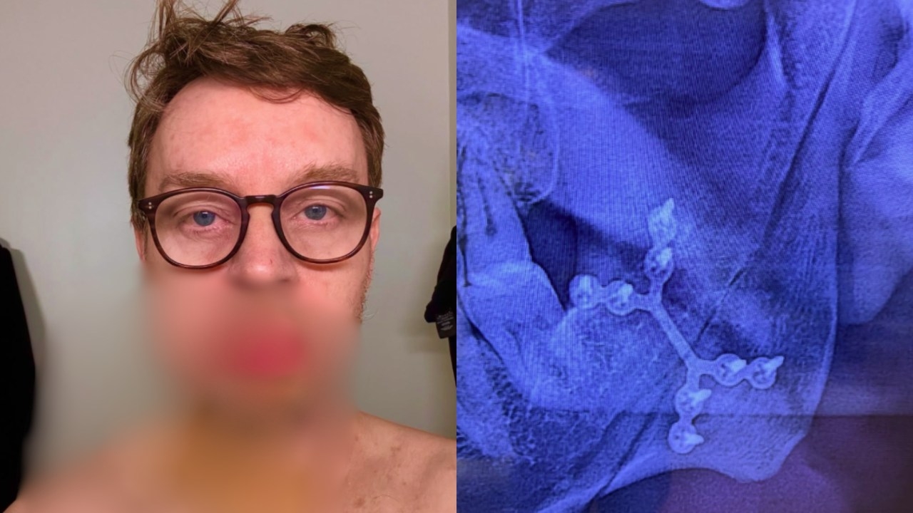 'Pool of blood': Aussie musician Darren Hayes reveals horrific injuries after suffering freak accident while getting out of bed