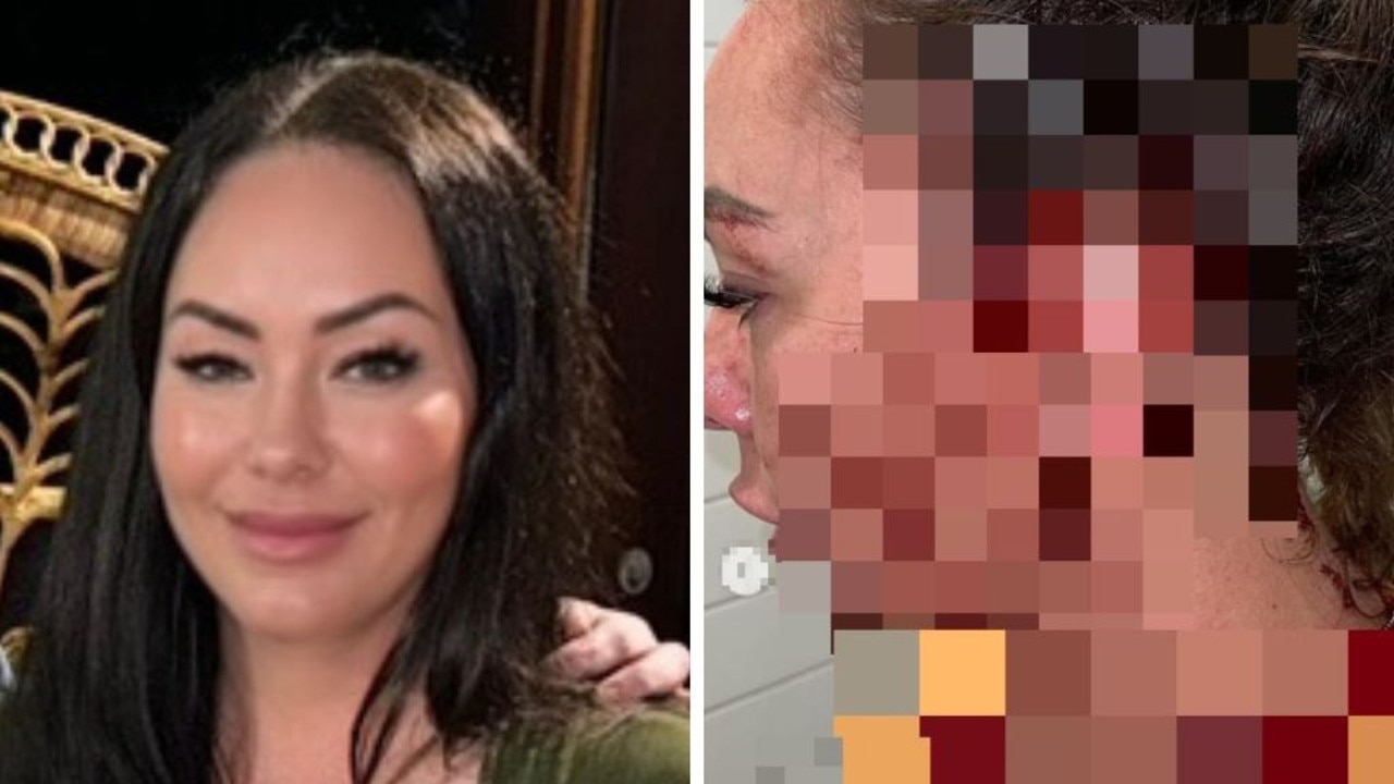 Sydney mum speaking out after horrific domestic violence assaults