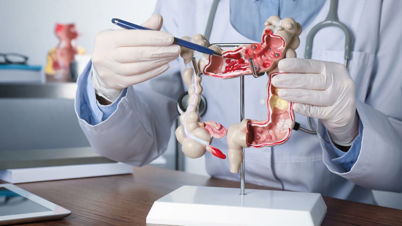 Study backs Rhythm's colorectal risk model