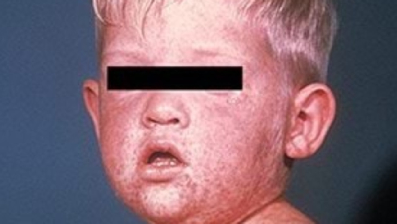 Victoria records worst measles outbreak in a decade
