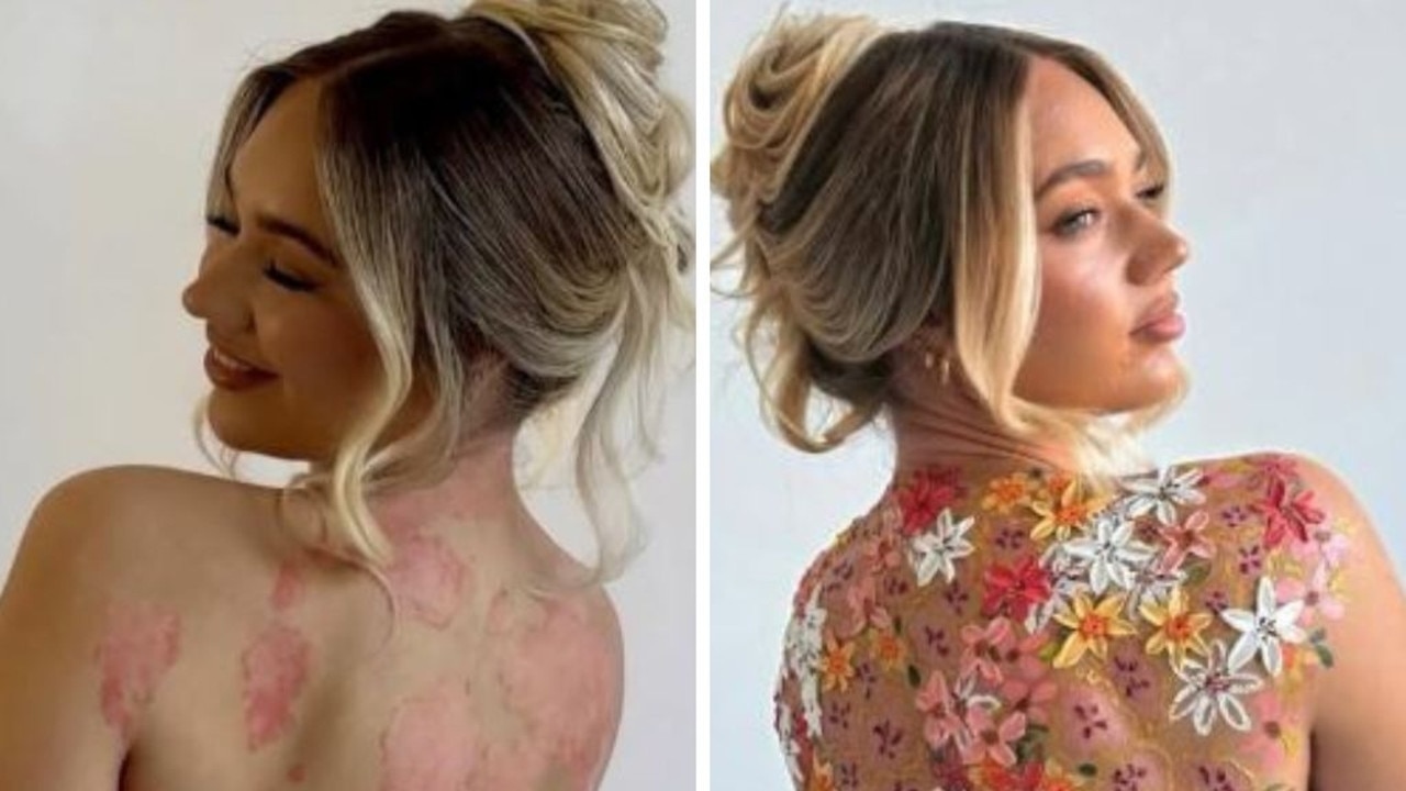 Content creator reveals life with consuming skin condition