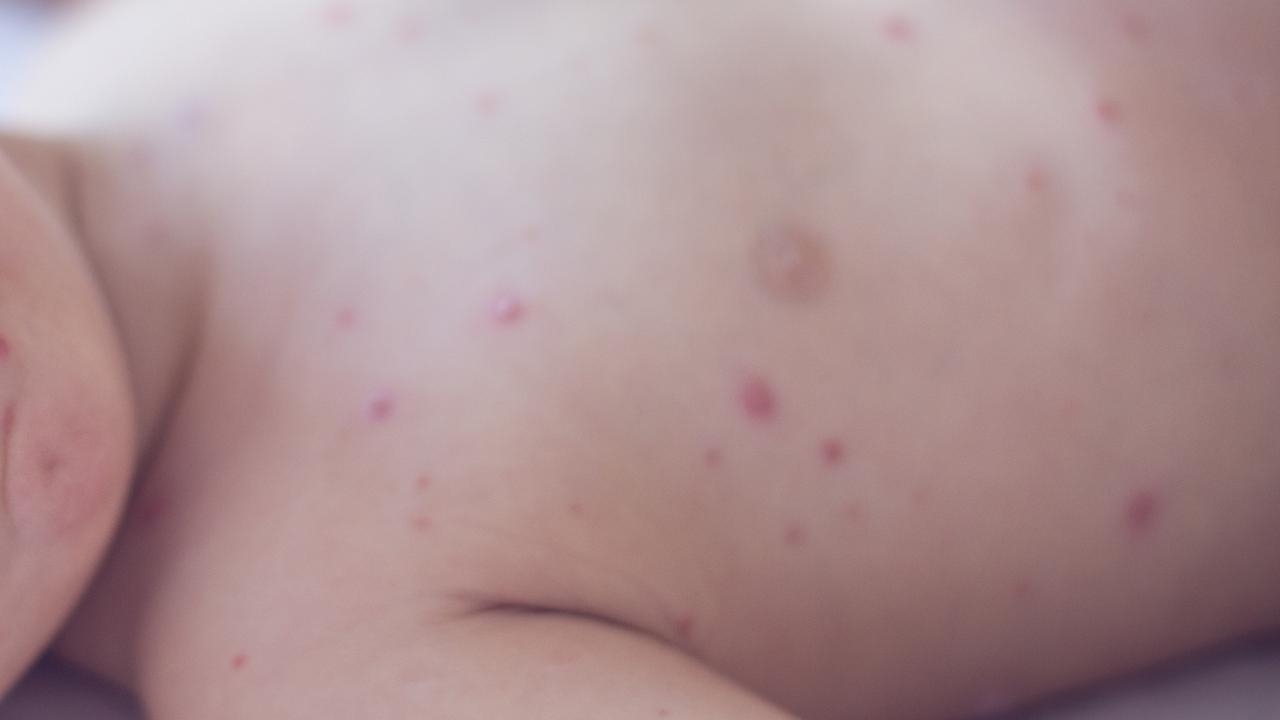 Measles warning after Bali traveller returns to Adelaide with highly infectious disease