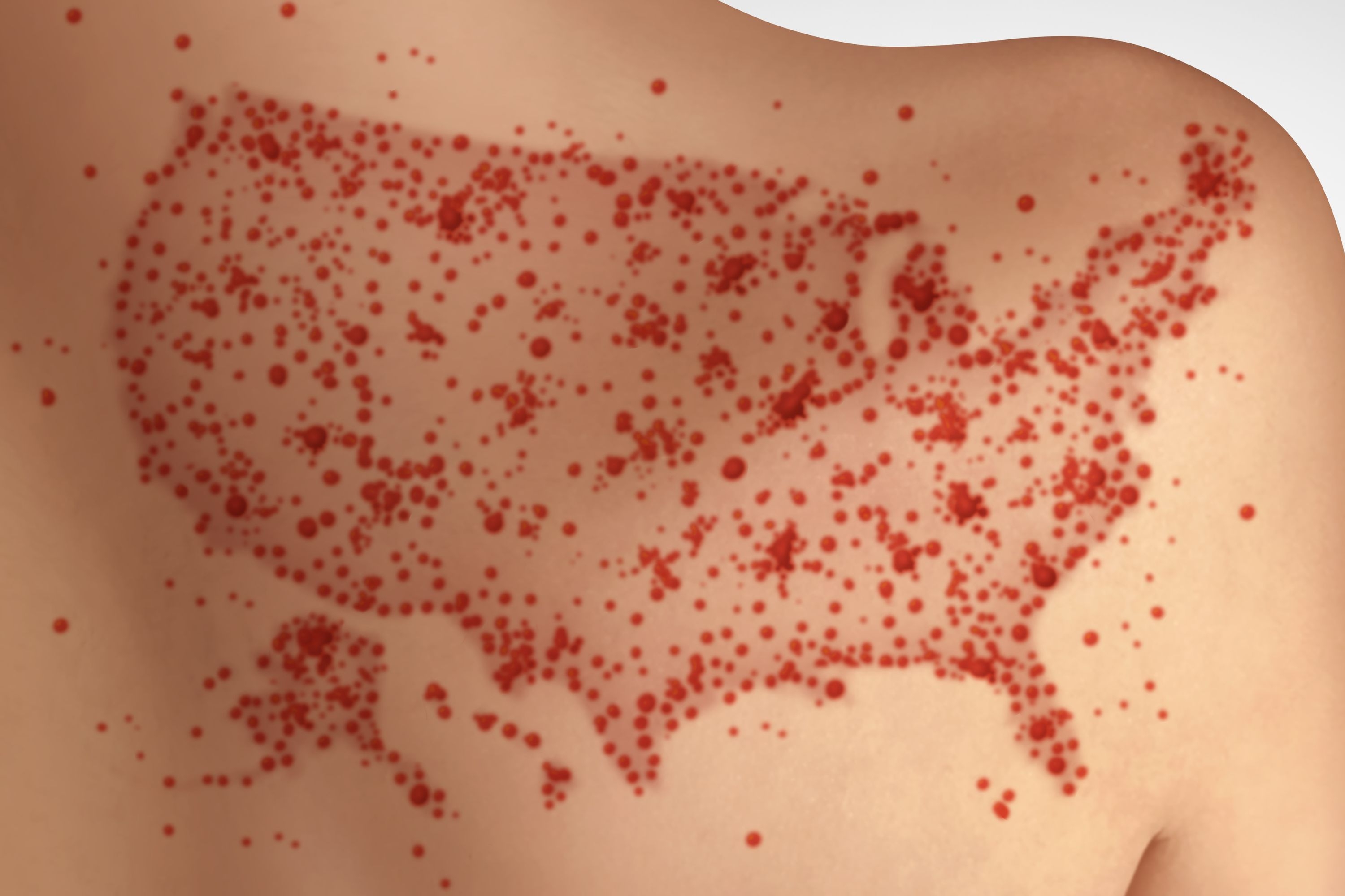Measles May Make Comeback as US 'on the Precipice of Disaster'