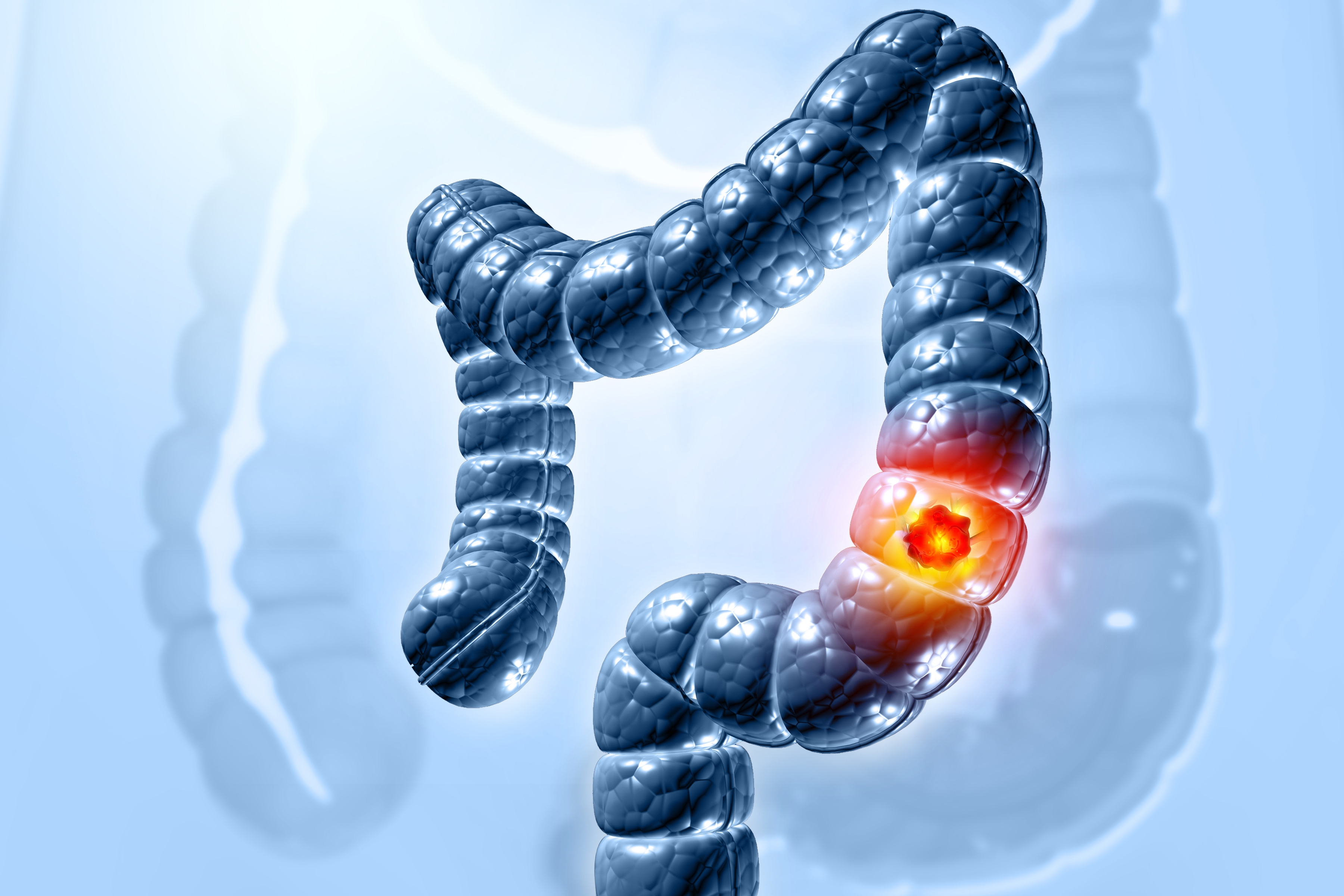 Higher Risk for Colorectal Cancer Linked to Bacteria