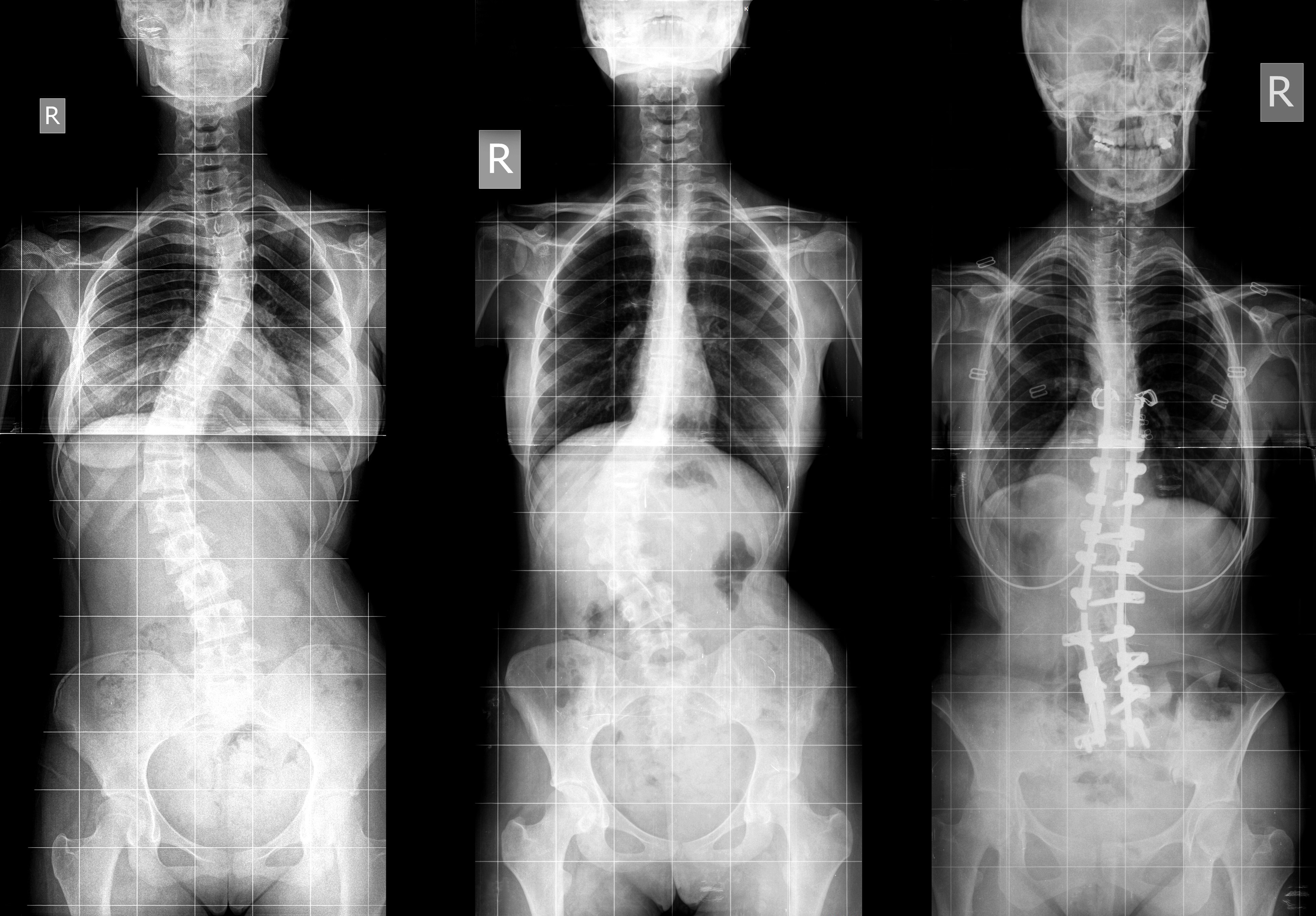 Internet Stunned As Before and After X-Rays of Back Surgery Go Viral