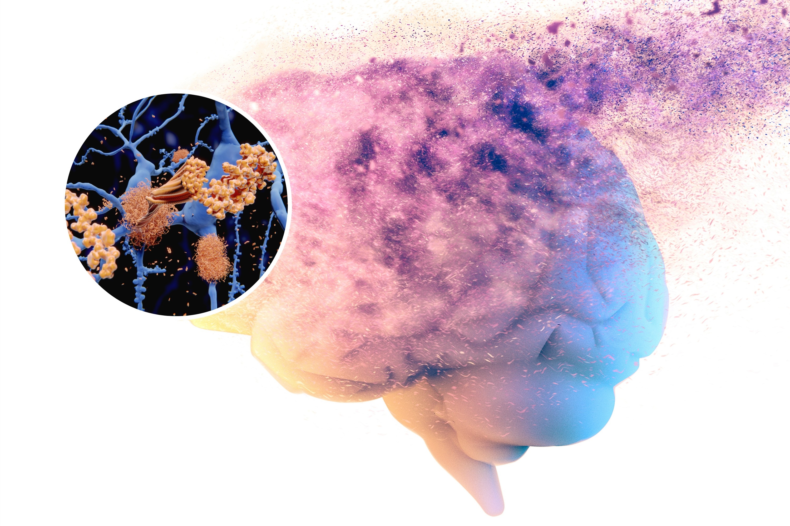 Scientists Map How Alzheimer's Begins in the Brain