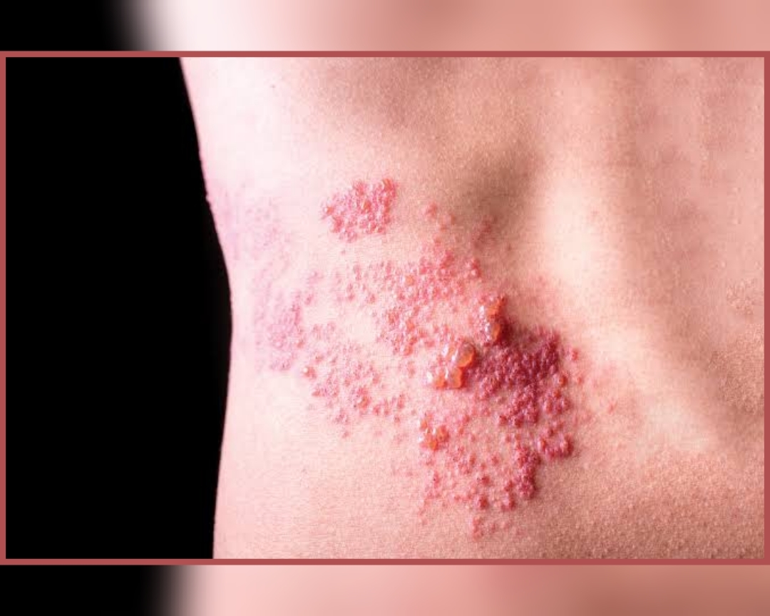 الحزام الناري… مرض فيروسي مؤلم يختبئ لسنوات ويظهر عند ضعف المناعة