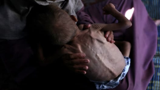 وفاة رضيع نتيجة سوء التغذية ونقص حليب الأطفال في غزة
