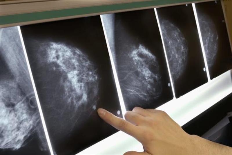 AI can identify women at risk of breast cancer - Health - Life & Style