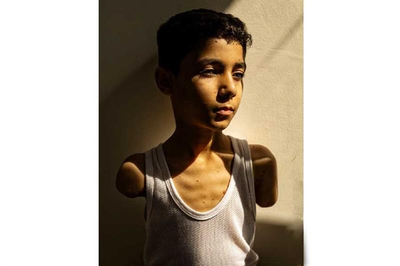 Amputee Palestinian boy image wins World Press Photo award - War on Gaza