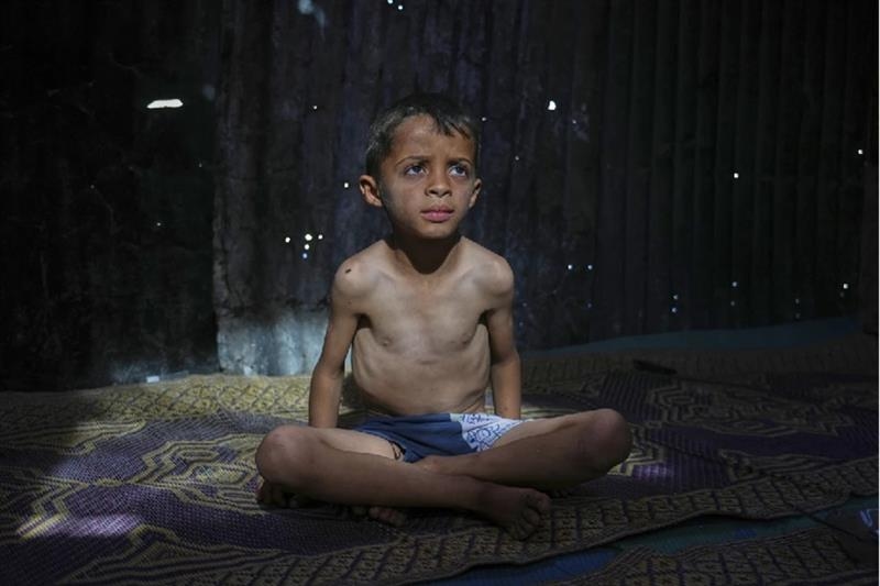 Malnutrition among Gaza children doubled under Israeli blockade: UN - War on Gaza