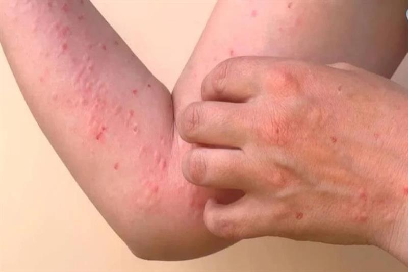 WHO sounds alarm on risk of chikungunya epidemic - Health - Life & Style