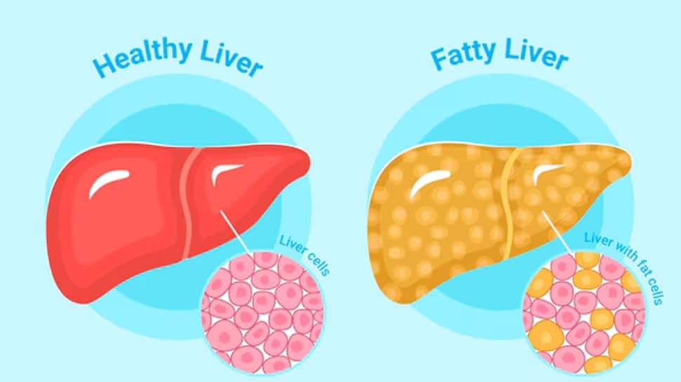 Is Sedentary Lifestyle Linked To Fatty Liver Disease? Expert Advice On MASLD