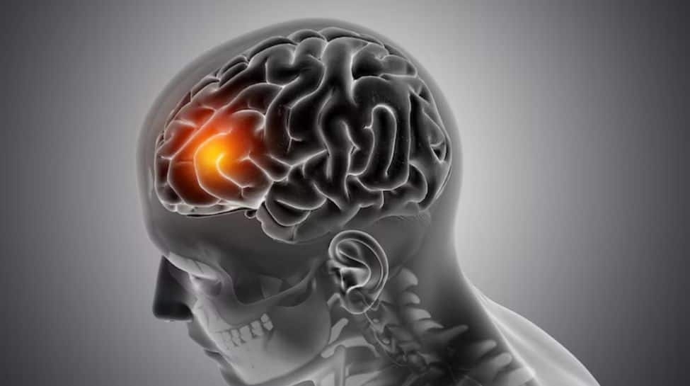 World Brain Tumour Day 2025: Early Diagnosis And Awareness Key To Brain Health For All Ages