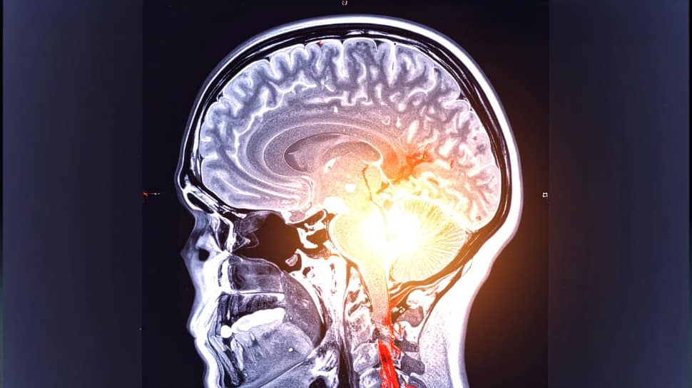 Oral And Gut Bacteria Linked To Worsening Dementia In Parkinsons: New Study Reveals Shocking Connection