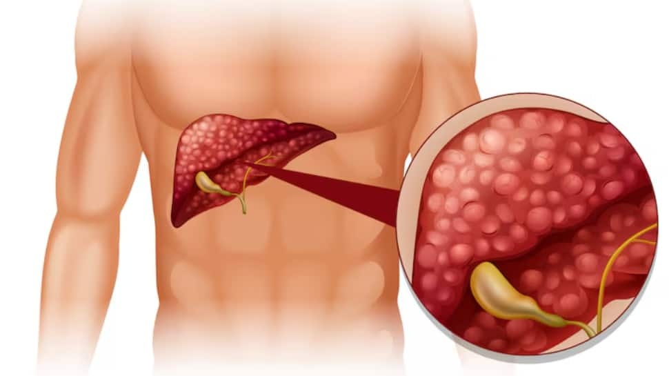 Breakthrough In Liver Cirrhosis Treatment: Indian Scientists Develop New Approach