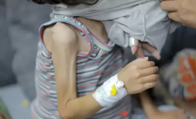 المكمِّلات الغذائية ممنوعة أيضًا.. آلاف الأطفال مهدَّدون بسوء تغذية قاتل في غزَّة