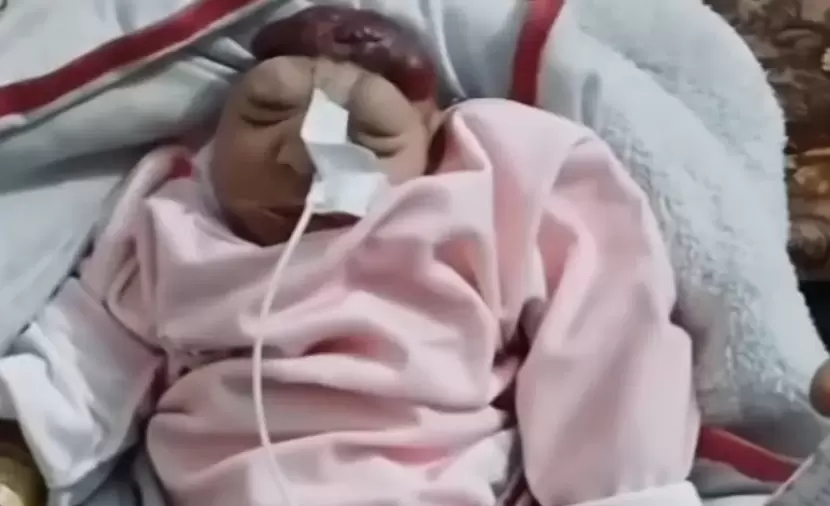 ضحايا الحرب.. أطفال يُولدون دون جمجمة وبأطراف مشوهة في غزة