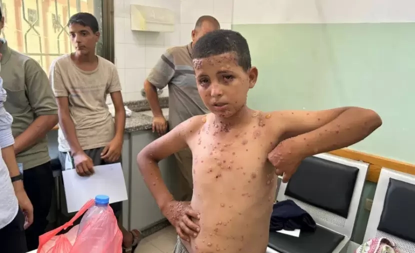 تقرير الأمراض الجلدية تفتك بأطفال غزة وسط انعدام الدواء