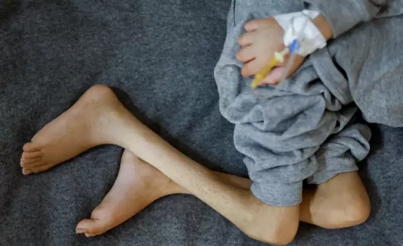 8 حالات وفاة نتيجة المجاعة وسوء التّغذية خلال الـ 24 ساعة الماضية