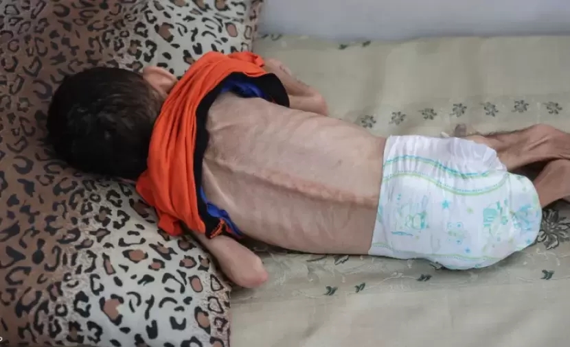 الفرا: أجساد الأطفال تحوَّلت إلى عظام يكسوها جلد ولا بدَّ من إدخال الحليب والمستلزمات الأساسية
