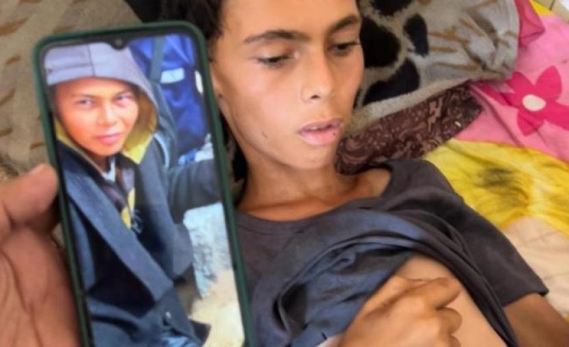 وفاة فتى بسبب الجوع وسوء التَّغذية في غزَّة