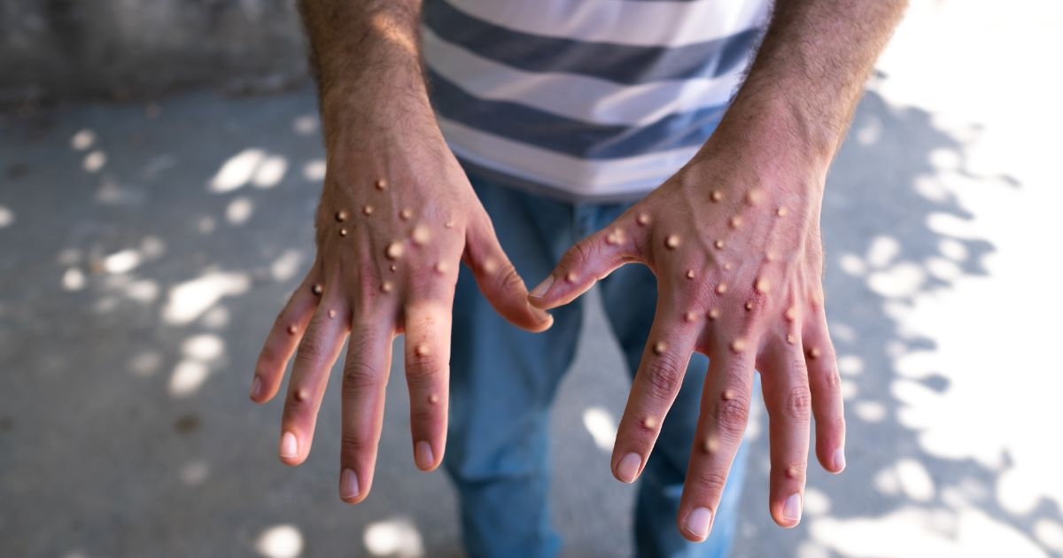 WHO says mpox outbreak still a global health emergency