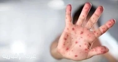 وزارة الصحة المصرية : انتقال جدرى القرود بين البشر محدود ولا يوجد حالات فى مصر