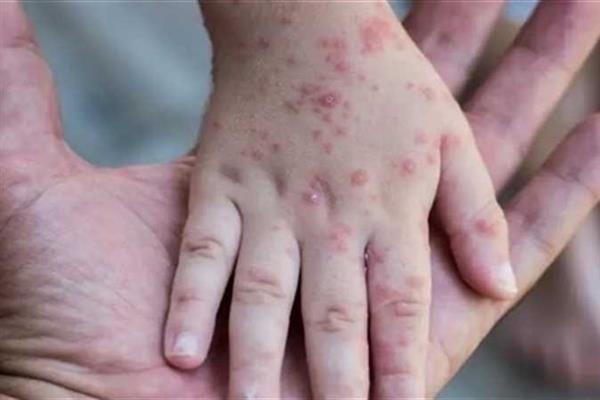 غينيا تسجل 206 حالات إصابة جديدة بفيروس جدري القردة