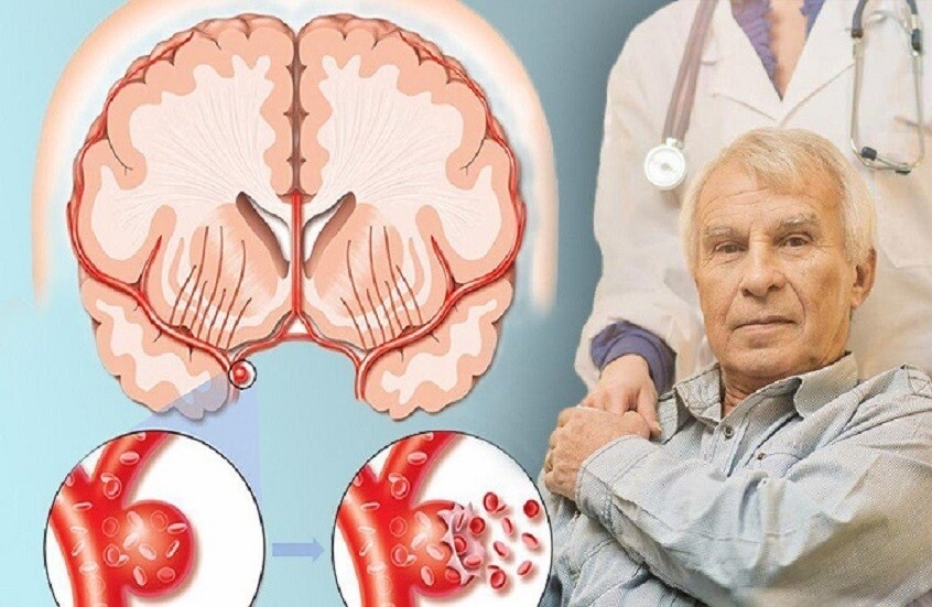 الذكاء الاصطناعي يساعد في اكتشاف جينات لها علاقة بالسكتة الدماغية