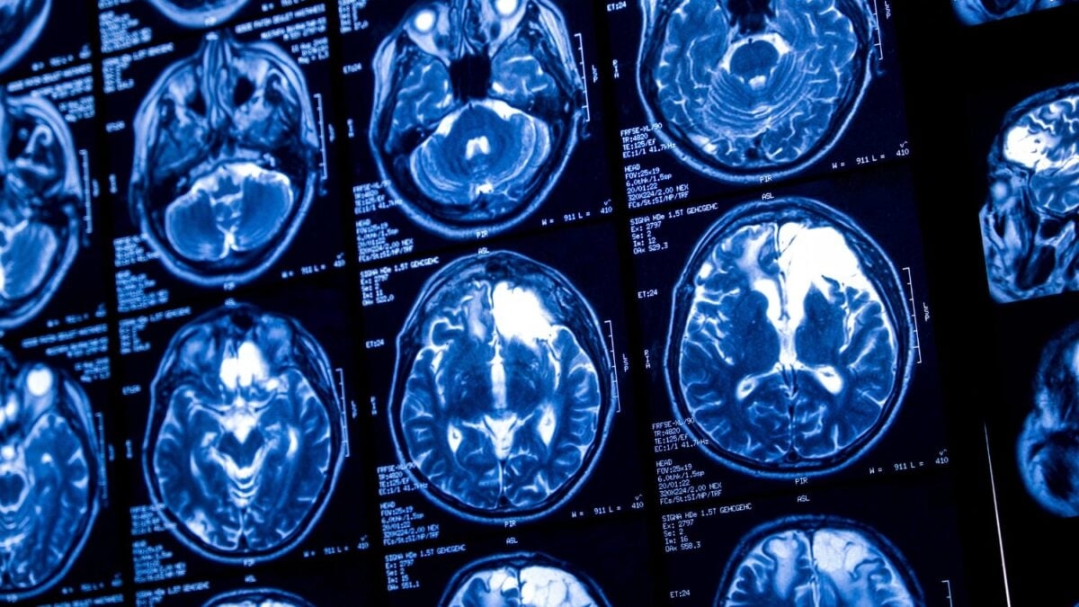 Sam Altman Reportedly Launch Rival Brain-Chip Startup to Compete With Musk's Neuralink