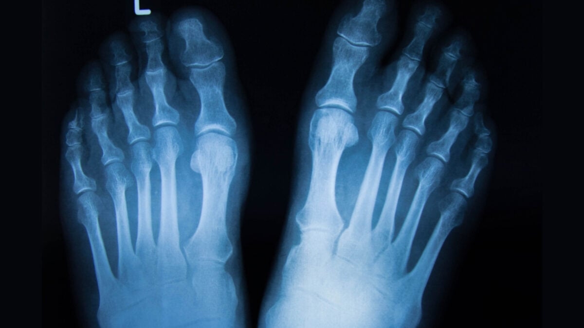 Rare Bone-Eating Cancer Replaced Man's Finger and Toe