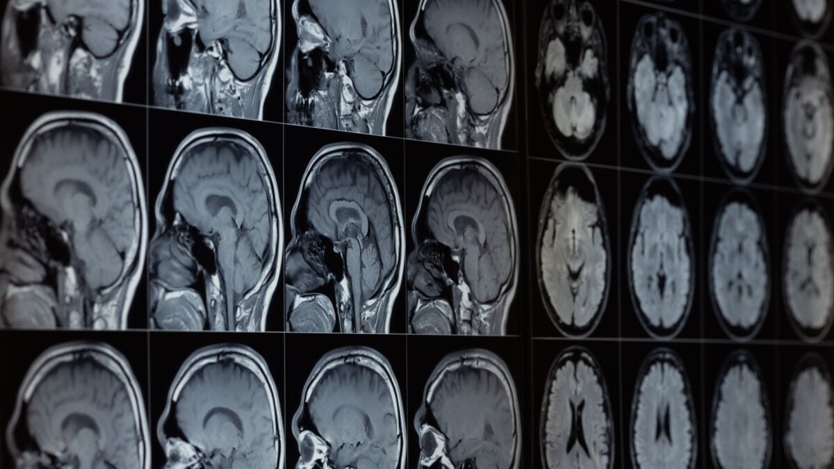 Our Brains Contain Lithium—and Its Loss Might Help Drive Alzheimer's, Study Finds