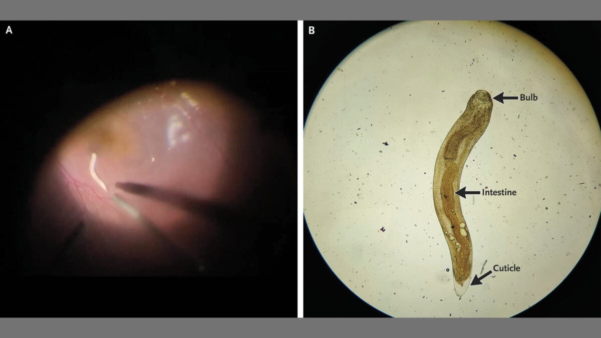 A Man's Eye Got Infested by a Worm, so Doctors Vacuumed Out the Eye Juices