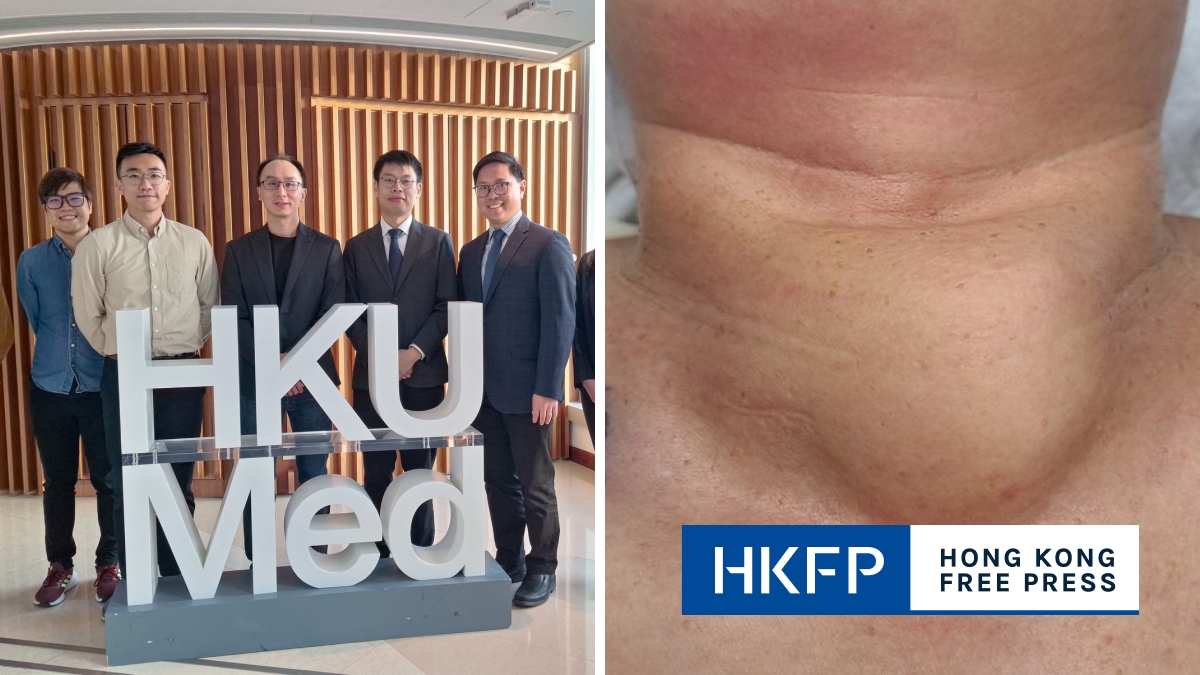 University of Hong Kong medical school develops world's first AI model for thyroid cancer diagnosis