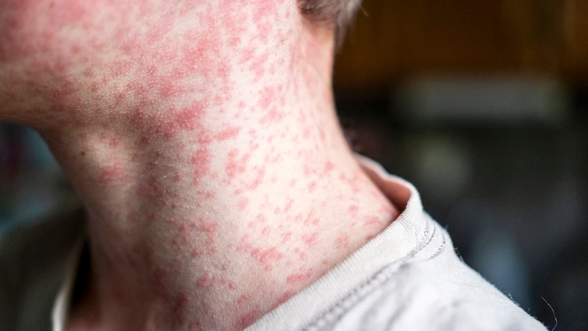 Major outbreak fears as measles hits baseball game attended by 40,000