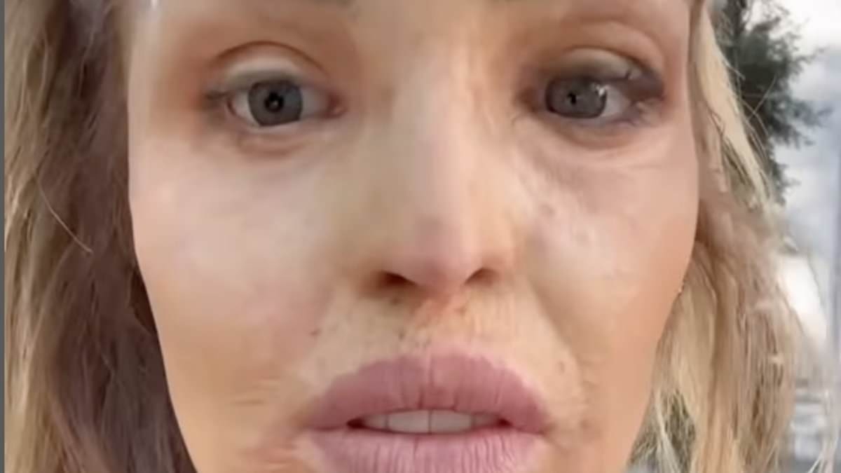 Katie Piper shows off her new glass eye in remarkable before and after shots after travelling to Hamburg for pioneering treatment