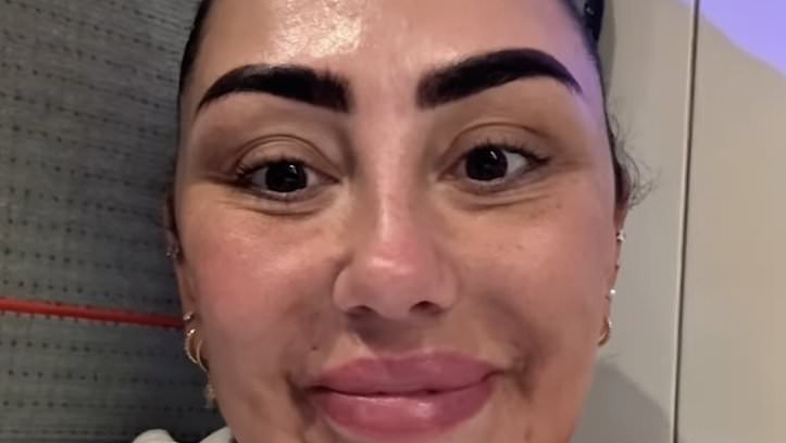 EXCLUSIVE Sophie Kasaei shows off dramatic results of getting face filler dissolved at £30m Botox clinic after an allergic reaction left her with PTSD