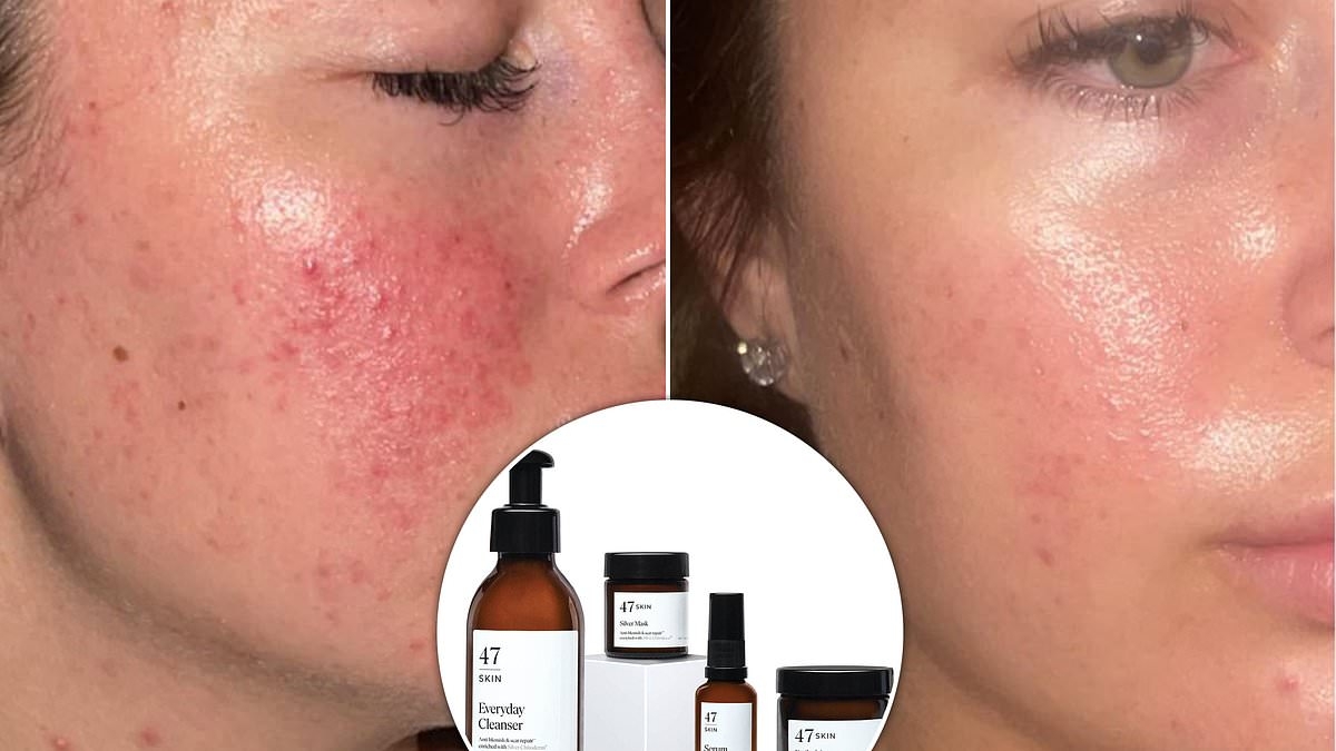 Top-rated skincare bundle for acne scars and blemishes is going viral for transforming skin FAST (plus, save 10%)