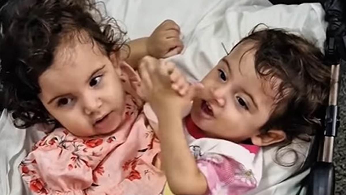 Conjoined twins attached at the chest, belly and pelvis are successfully separated in painstaking 15-hour operation